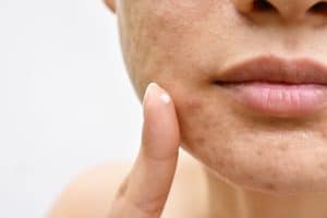 Lees meer over het artikel Jeugdpuistjes die niet verdwijnen… Welke acné behandeling werkt?
